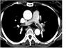 pulmonary embolism