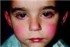 kawasaki disease